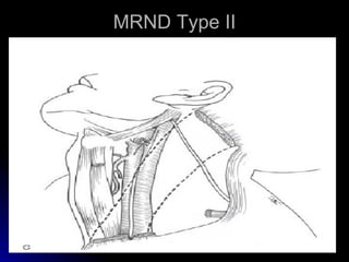 MRND Type II 