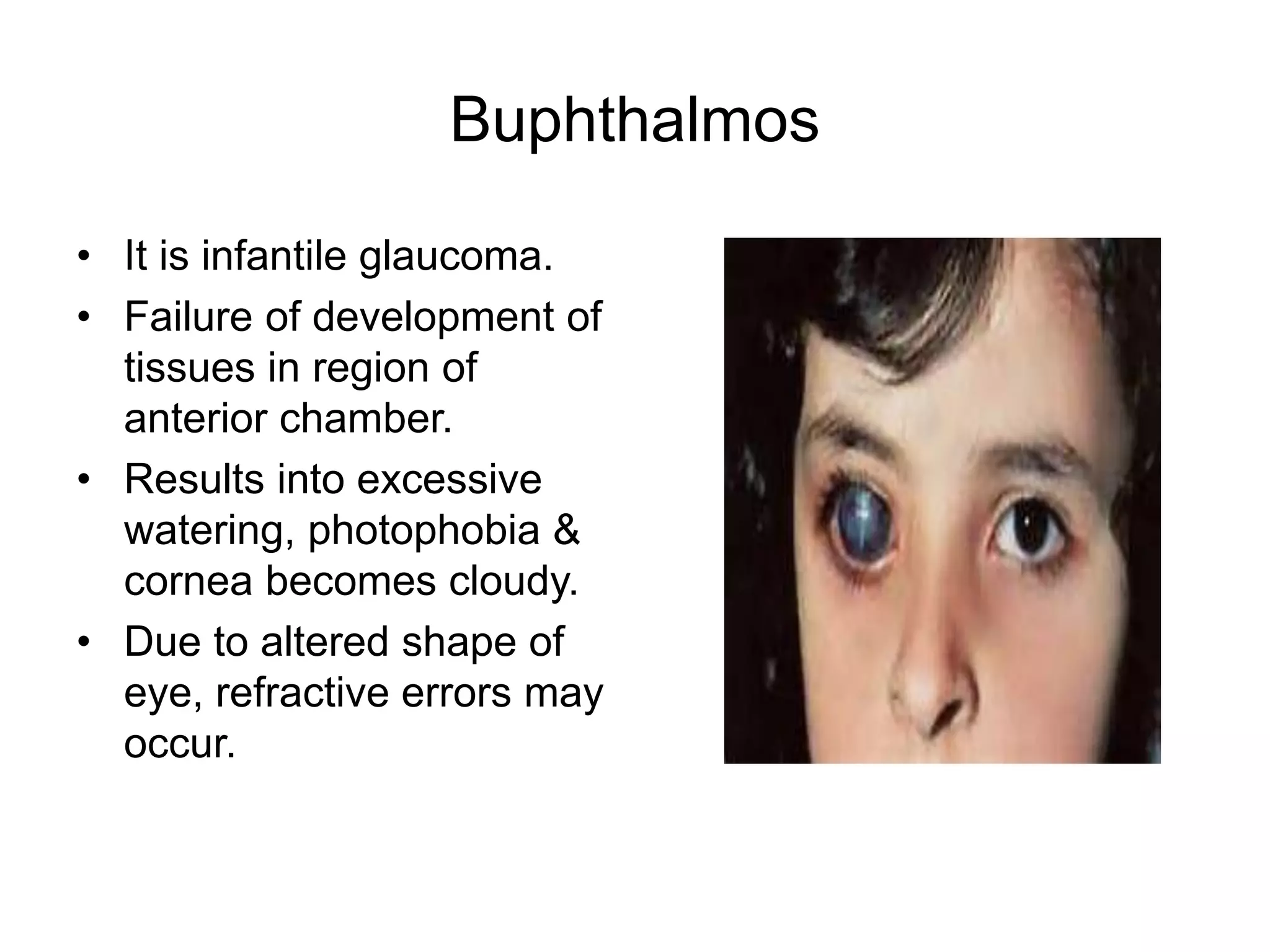 Buphthalmos
• It is infantile glaucoma.
• Failure of development of
tissues in region of
anterior chamber.
• Results into excessive
watering, photophobia &
cornea becomes cloudy.
• Due to altered shape of
eye, refractive errors may
occur.
 