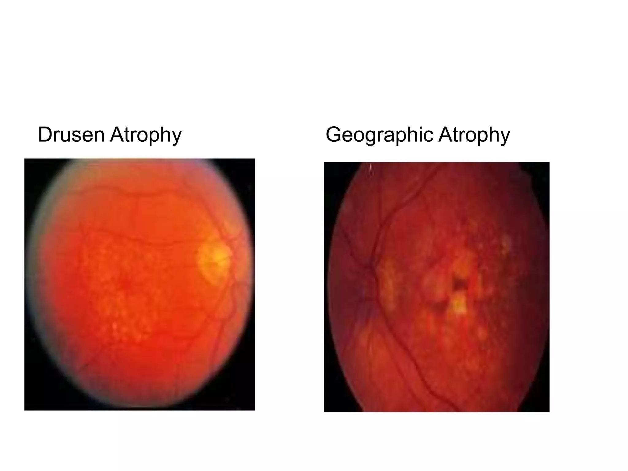 Drusen Atrophy Geographic Atrophy
 