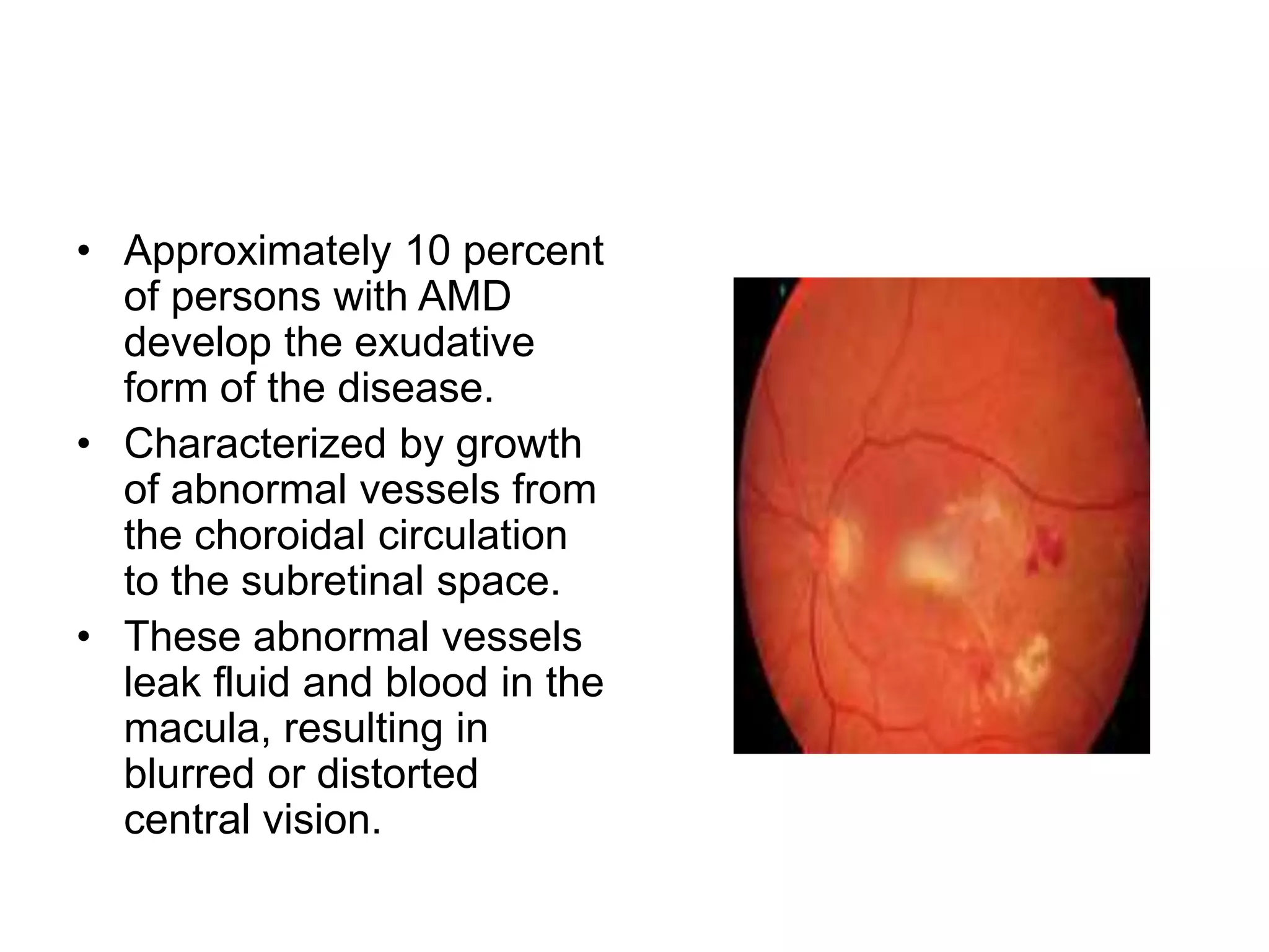 • Approximately 10 percent
of persons with AMD
develop the exudative
form of the disease.
• Characterized by growth
of abnormal vessels from
the choroidal circulation
to the subretinal space.
• These abnormal vessels
leak fluid and blood in the
macula, resulting in
blurred or distorted
central vision.
 
