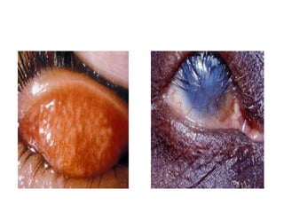 Overview of ophthalmologic causes of visual impairment | PPTX