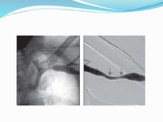 Overview of Stents in Interventional Radiology.pptx