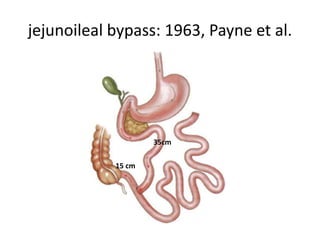 jejunoileal bypass: 1963, Payne et al.
35cm
15 cm
 