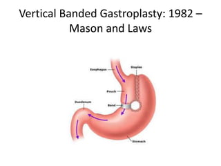 Vertical Banded Gastroplasty: 1982 –
Mason and Laws
 
