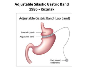 Adjustable Silastic Gastric Band
1986 - Kuzmak
 