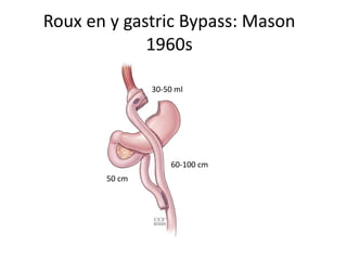 Roux en y gastric Bypass: Mason
1960s
60-100 cm
50 cm
30-50 ml
 