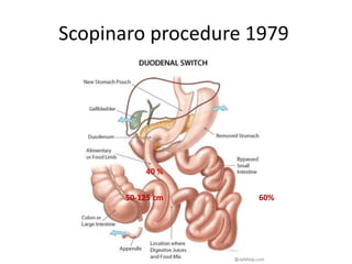 Scopinaro procedure 1979
50-125 cm 60%
40 %
 