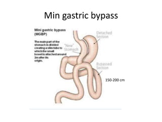 Min gastric bypass
150-200 cm
 
