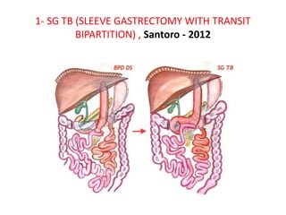 1- SG TB (SLEEVE GASTRECTOMY WITH TRANSIT
BIPARTITION) , Santoro - 2012
 