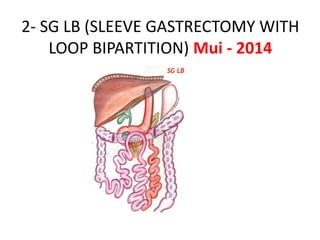 2- SG LB (SLEEVE GASTRECTOMY WITH
LOOP BIPARTITION) Mui - 2014
 