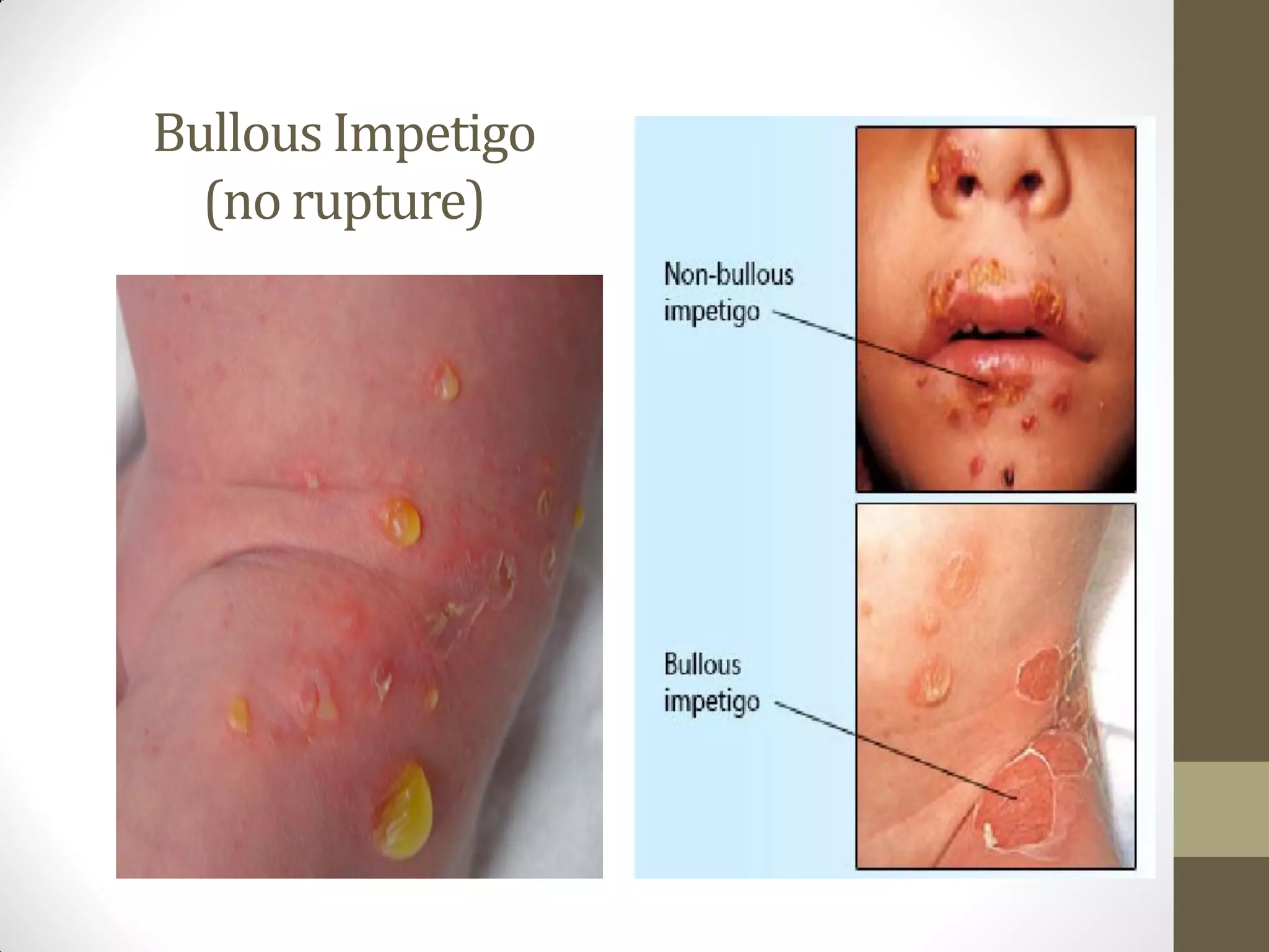 Overview skin disease & impetigo ping | PDF