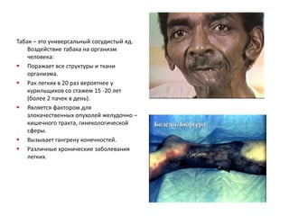 Табак – это универсальный сосудистый яд. Воздействие табака на организм человека:Поражает все структуры и ткани организма.