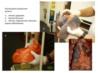 Рак легких в 20 раз вероятнее у курильщиков со стажем 15 -20 лет (более 2 пачек в день).