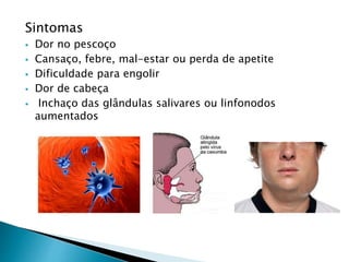 Sintomas
 Dor no pescoço
 Cansaço, febre, mal-estar ou perda de apetite
 Dificuldade para engolir
 Dor de cabeça
 Inchaço das glândulas salivares ou linfonodos
aumentados
 