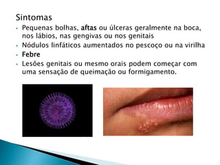 Sintomas
 Pequenas bolhas, aftas ou úlceras geralmente na boca,
nos lábios, nas gengivas ou nos genitais
 Nódulos linfáticos aumentados no pescoço ou na virilha
 Febre
 Lesões genitais ou mesmo orais podem começar com
uma sensação de queimação ou formigamento.
 
