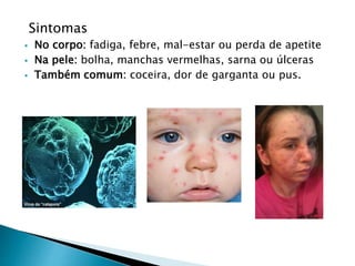 Sintomas
 No corpo: fadiga, febre, mal-estar ou perda de apetite
 Na pele: bolha, manchas vermelhas, sarna ou úlceras
 Também comum: coceira, dor de garganta ou pus.
 