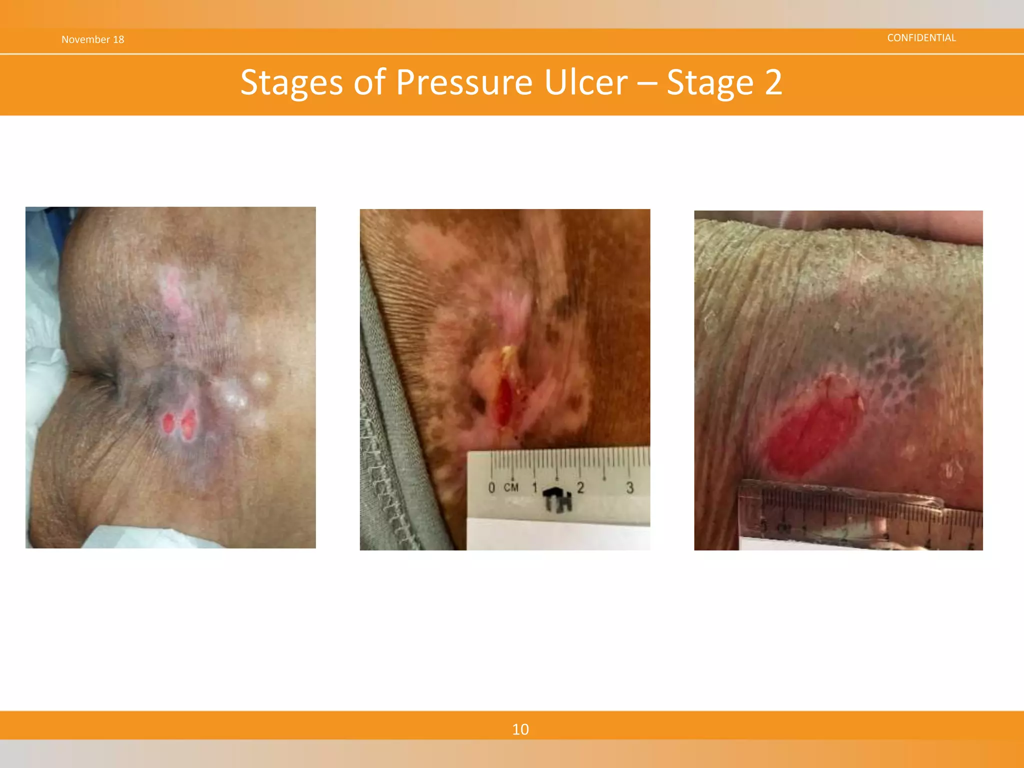 CONFIDENTIALNovember 18
10
Stages of Pressure Ulcer – Stage 2
 