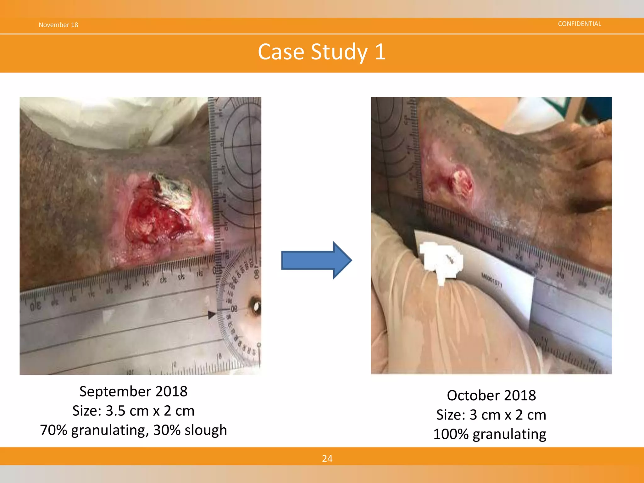 CONFIDENTIALNovember 18
24
Case Study 1
September 2018
Size: 3.5 cm x 2 cm
70% granulating, 30% slough
October 2018
Size: 3 cm x 2 cm
100% granulating
 