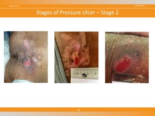 CONFIDENTIALNovember 18
10
Stages of Pressure Ulcer – Stage 2
 