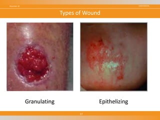 CONFIDENTIALNovember 18
17
Types of Wound
Granulating Epithelizing
 