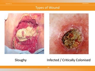 CONFIDENTIALNovember 18
18
Types of Wound
Sloughy Infected / Critically Colonised
 