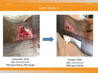 CONFIDENTIALNovember 18
24
Case Study 1
September 2018
Size: 3.5 cm x 2 cm
70% granulating, 30% slough
October 2018
Size: 3 cm x 2 cm
100% granulating
 