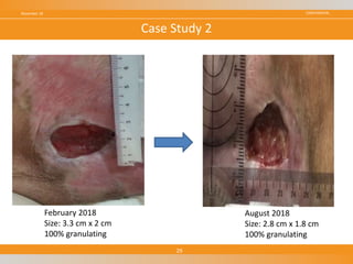 CONFIDENTIALNovember 18
29
Case Study 2
February 2018
Size: 3.3 cm x 2 cm
100% granulating
August 2018
Size: 2.8 cm x 1.8 cm
100% granulating
 