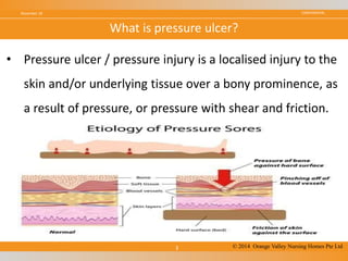 CONFIDENTIALNovember 18
3
What is pressure ulcer?
© 2014 Orange Valley Nursing Homes Pte Ltd
• Pressure ulcer / pressure injury is a localised injury to the
skin and/or underlying tissue over a bony prominence, as
a result of pressure, or pressure with shear and friction.
 