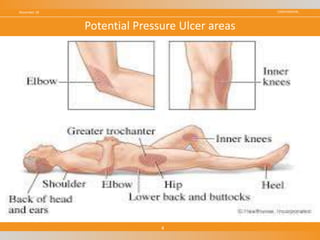 CONFIDENTIALNovember 18
4
Potential Pressure Ulcer areas
 