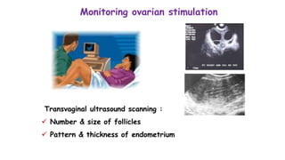 Monitoring ovarian stimulation
Transvaginal ultrasound scanning :
 Number & size of follicles
 Pattern & thickness of endometrium
 