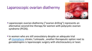 Laparoscopic ovarian diathermy
 Laparoscopic ovarian diathermy ("ovarian drilling") represents an
alternative second-line therapy for women with polycystic ovarian
syndrome (PCOS).
 In women who are still anovulatory despite an adequate trial
of clomiphene citrate / Letrozole , another therapeutic option next to
gonadotropins is laparoscopic surgery with electrocautery or laser.
 