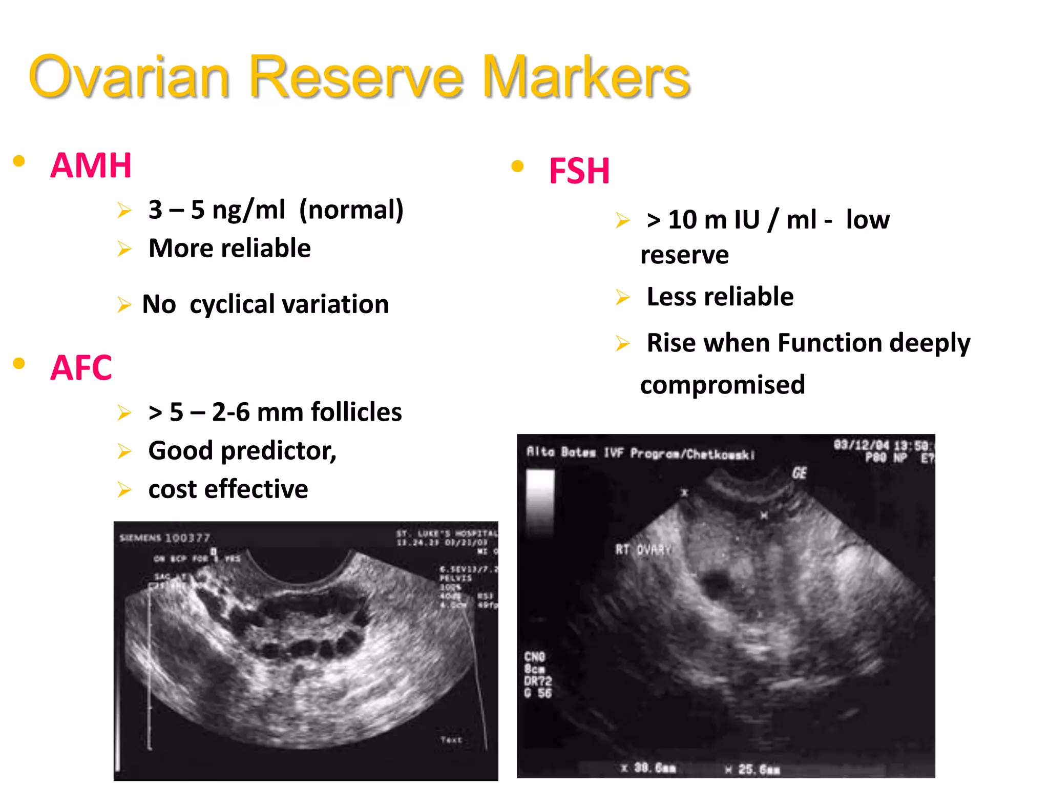 Ovarian Reserve Markers
• AMH
 3 – 5 ng/ml (normal)
 More reliable
 No cyclical variation
• AFC
 > 5 – 2-6 mm follicles
 Good predictor,
 cost effective
• FSH
 > 10 m IU / ml - low
reserve
 Less reliable
 Rise when Function deeply
compromised
 