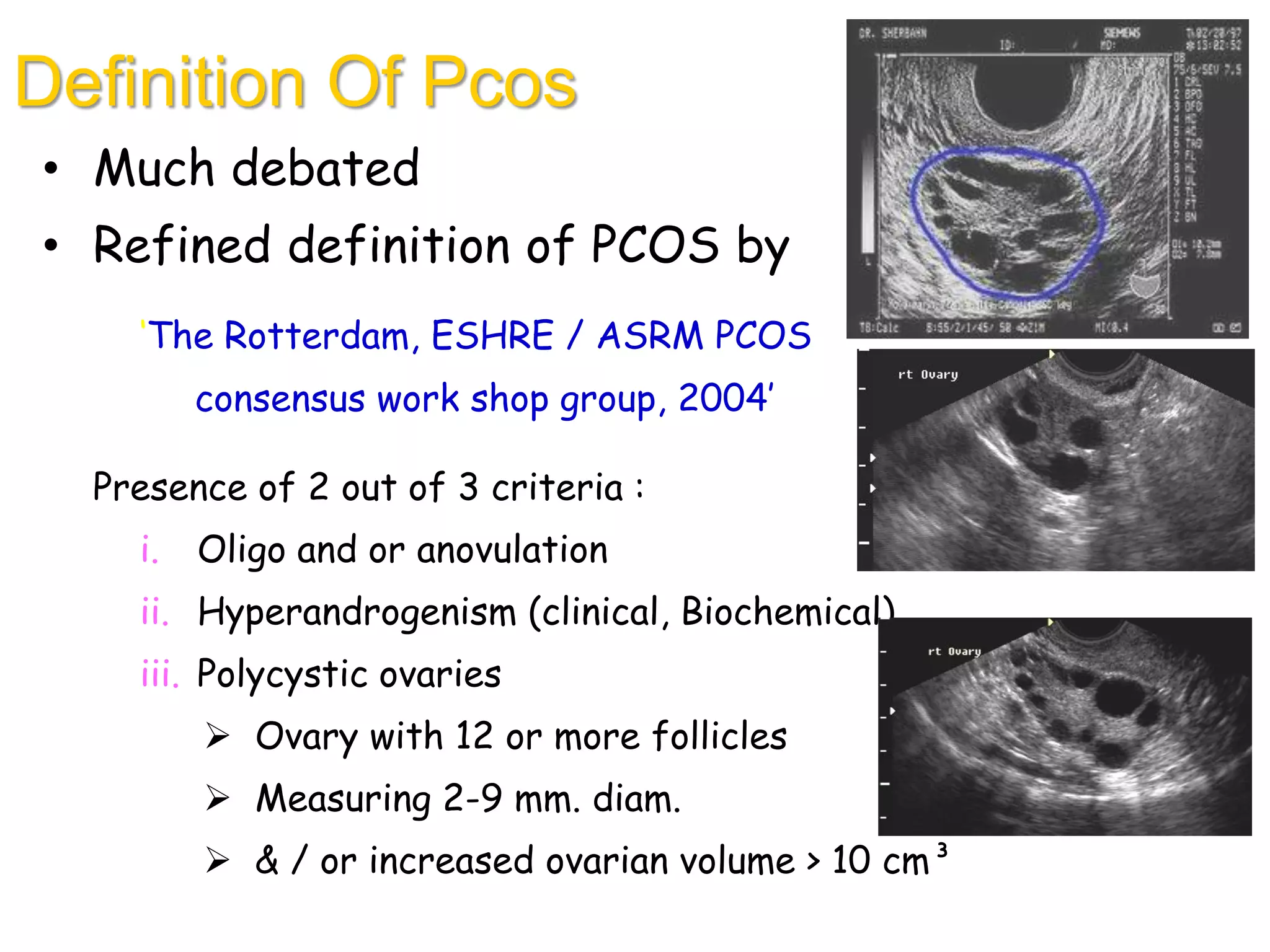 Definition Of Pcos
• Much debated
• Refined definition of PCOS by
‘The Rotterdam, ESHRE / ASRM PCOS
consensus work shop group, 2004’
Presence of 2 out of 3 criteria :
i. Oligo and or anovulation
ii. Hyperandrogenism (clinical, Biochemical)
iii. Polycystic ovaries
 Ovary with 12 or more follicles
 Measuring 2-9 mm. diam.
 & / or increased ovarian volume > 10 cm³
 