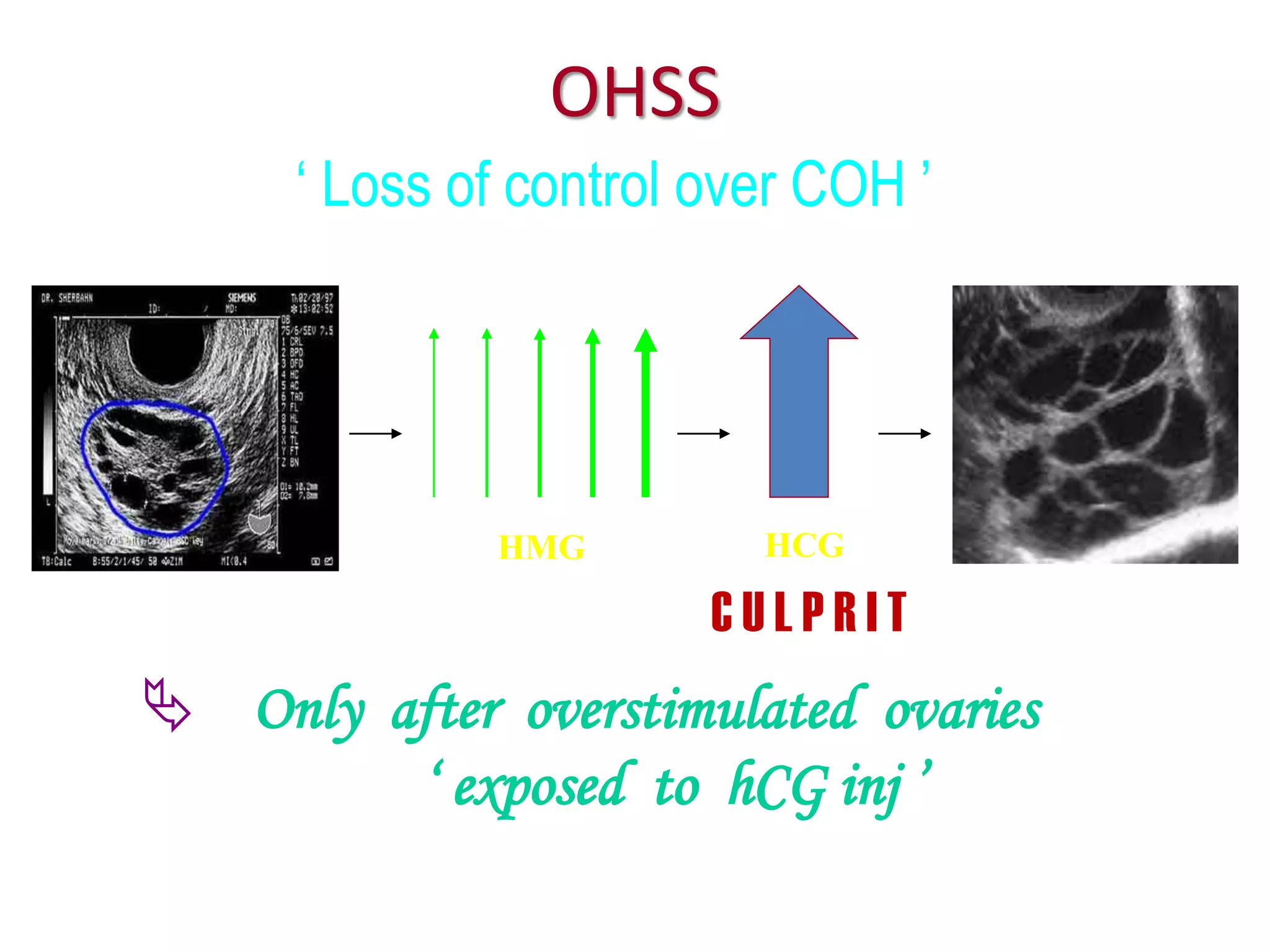 OHSS
‘ Loss of control over COH ’
 Only after overstimulated ovaries
‘ exposed to hCG inj ’
C U L P R I T
HMG HCG
 