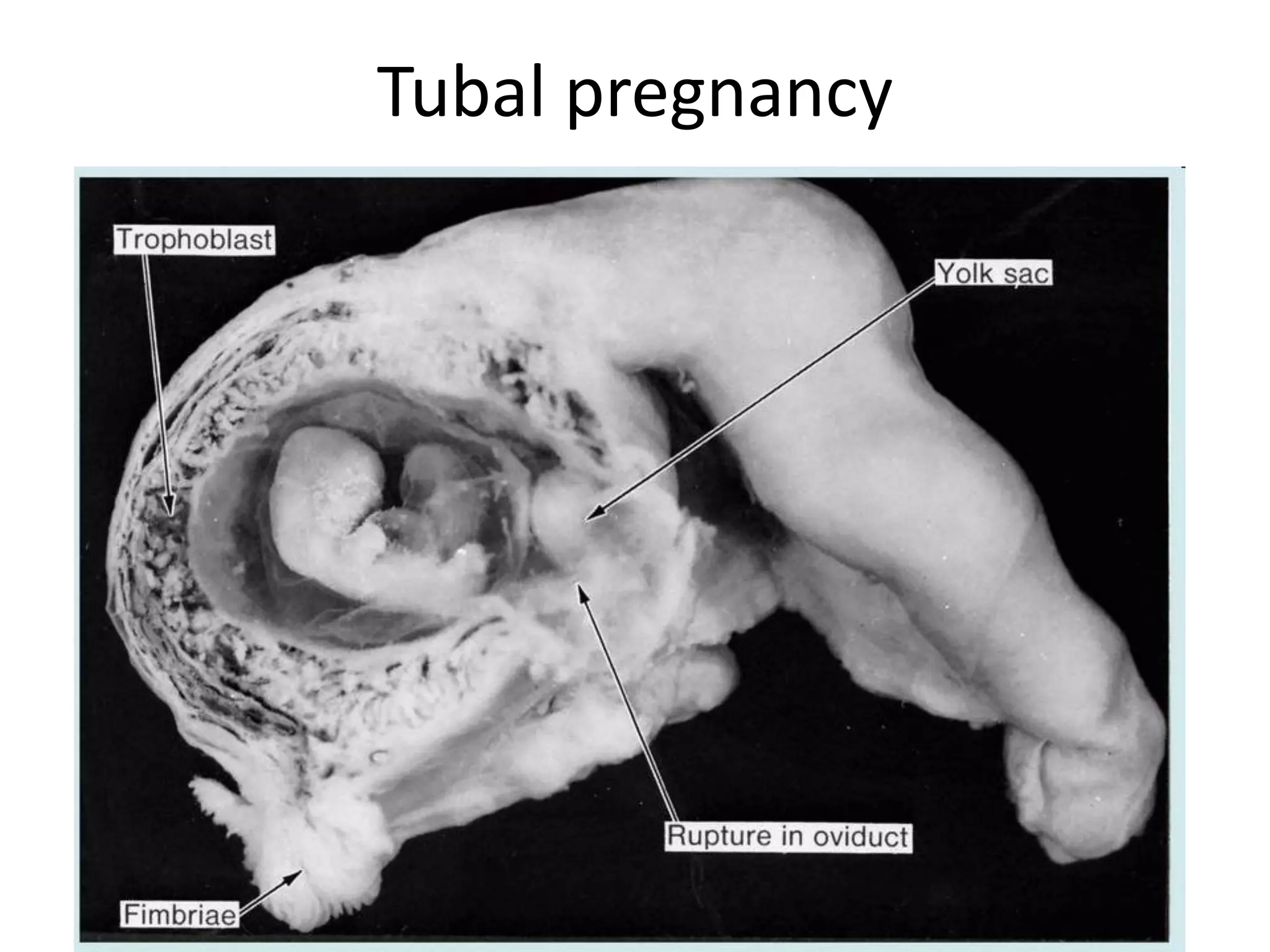 Tubal pregnancy
 