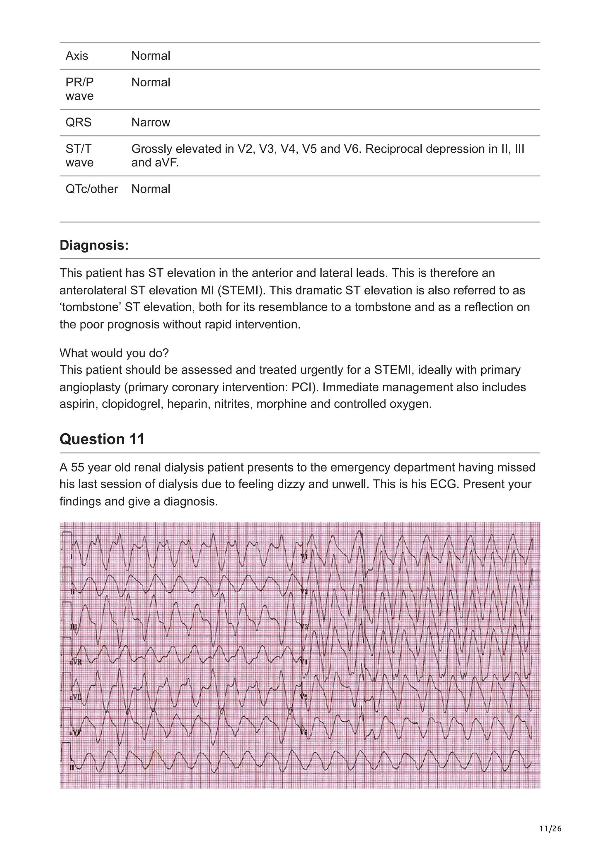 11/26
Axis Normal
PR/P
wave
Normal
QRS Narrow
ST/T
wave
Grossly elevated in V2, V3, V4, V5 and V6. Reciprocal depression in II, III
and aVF.
QTc/other Normal
Diagnosis:
This patient has ST elevation in the anterior and lateral leads. This is therefore an
anterolateral ST elevation MI (STEMI). This dramatic ST elevation is also referred to as
‘tombstone’ ST elevation, both for its resemblance to a tombstone and as a reflection on
the poor prognosis without rapid intervention.
What would you do?
This patient should be assessed and treated urgently for a STEMI, ideally with primary
angioplasty (primary coronary intervention: PCI). Immediate management also includes
aspirin, clopidogrel, heparin, nitrites, morphine and controlled oxygen.
Question 11
A 55 year old renal dialysis patient presents to the emergency department having missed
his last session of dialysis due to feeling dizzy and unwell. This is his ECG. Present your
findings and give a diagnosis.
 