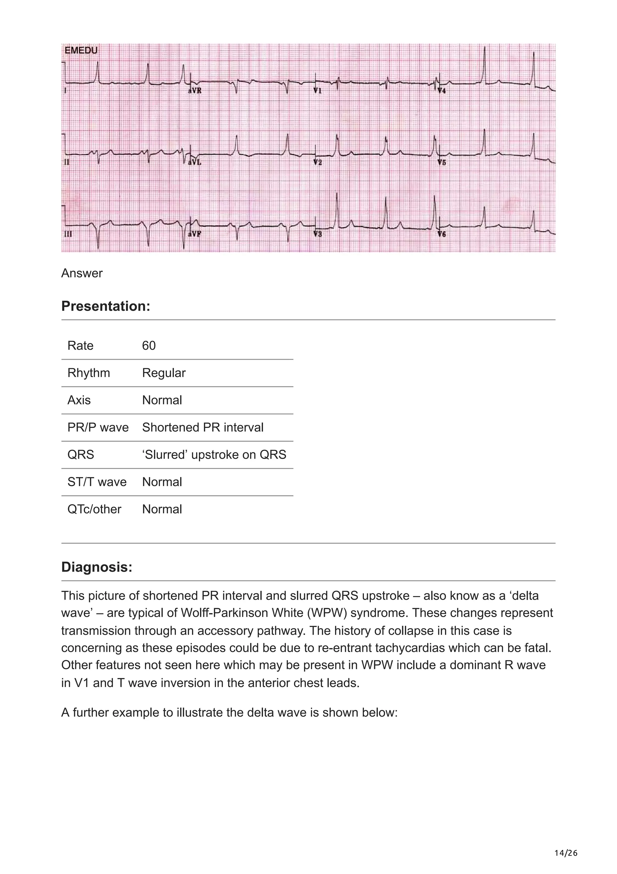 14/26
Answer
Presentation:
Rate 60
Rhythm Regular
Axis Normal
PR/P wave Shortened PR interval
QRS ‘Slurred’ upstroke on QRS
ST/T wave Normal
QTc/other Normal
Diagnosis:
This picture of shortened PR interval and slurred QRS upstroke – also know as a ‘delta
wave’ – are typical of Wolff-Parkinson White (WPW) syndrome. These changes represent
transmission through an accessory pathway. The history of collapse in this case is
concerning as these episodes could be due to re-entrant tachycardias which can be fatal.
Other features not seen here which may be present in WPW include a dominant R wave
in V1 and T wave inversion in the anterior chest leads.
A further example to illustrate the delta wave is shown below:
 