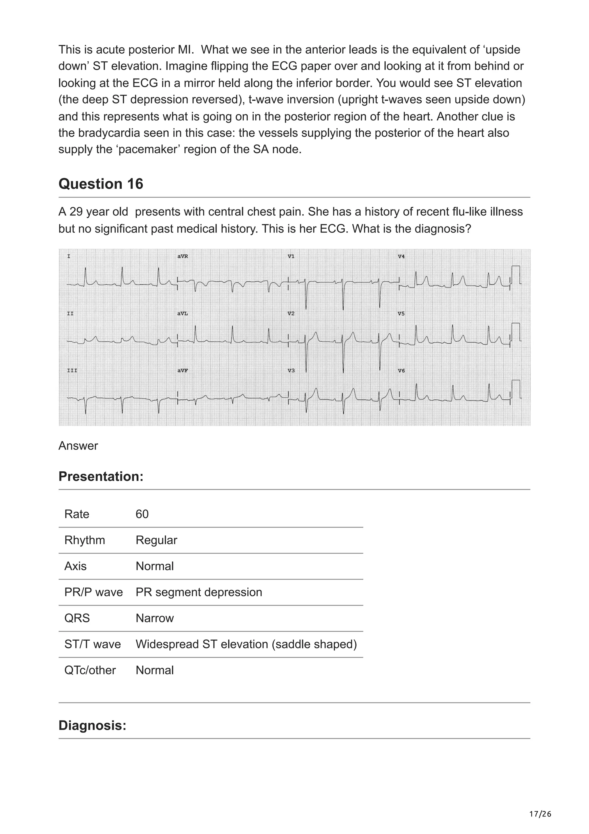 17/26
This is acute posterior MI. What we see in the anterior leads is the equivalent of ‘upside
down’ ST elevation. Imagine flipping the ECG paper over and looking at it from behind or
looking at the ECG in a mirror held along the inferior border. You would see ST elevation
(the deep ST depression reversed), t-wave inversion (upright t-waves seen upside down)
and this represents what is going on in the posterior region of the heart. Another clue is
the bradycardia seen in this case: the vessels supplying the posterior of the heart also
supply the ‘pacemaker’ region of the SA node.
Question 16
A 29 year old presents with central chest pain. She has a history of recent flu-like illness
but no significant past medical history. This is her ECG. What is the diagnosis?
Answer
Presentation:
Rate 60
Rhythm Regular
Axis Normal
PR/P wave PR segment depression
QRS Narrow
ST/T wave Widespread ST elevation (saddle shaped)
QTc/other Normal
Diagnosis:
 