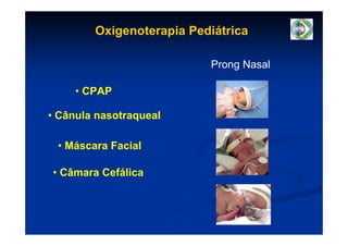 Oxigenoterapia Pediátrica

                          Prong Nasal

     • CPAP

• Cânula nasotraqueal

 • Máscara Facial

• Câmara Cefálica
 