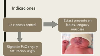 Indicaciones
La cianosis central
Estará presente en
labios, lengua y
mucosas
Signo de PaO2 <50 y
saturación <85%
 
