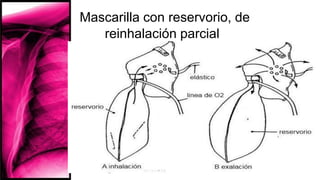 Mascarilla con reservorio, de
reinhalación parcial
 