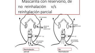 Mascarilla con reservorio, de
no reinhalación v/s
reinhalación parcial
Reinhalación
parcial
No
Reinhalación
 