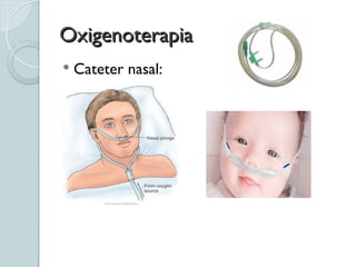 Oxigenoterapia
Oxigenoterapia
 Cateter nasal:
 