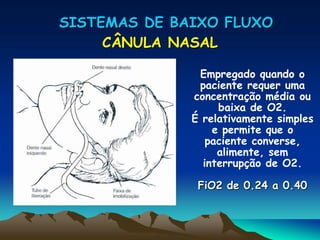 SISTEMAS DE BAIXO FLUXO
CÂNULA NASAL
Empregado quando o
paciente requer uma
concentração média ou
baixa de O2.
É relativamente simples
e permite que o
paciente converse,
alimente, sem
interrupção de O2.
FiO2 de 0.24 a 0.40
 