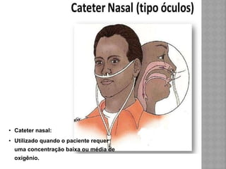 • Cateter nasal:
• Utilizado quando o paciente requer
uma concentração baixa ou média de
oxigênio.
 