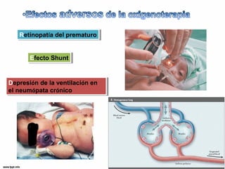 RReettininooppaattíaía d deel lp prreemmaattuurroo 
EEffeeccttoo S Shhuunntt 
Depresión de la ventilación en 
el neumópata crónico 
Depresión de la ventilación en 
el neumópata crónico 
 