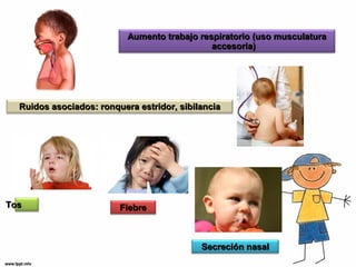 AAuummeennttoo ttrraabbaajjoo rreessppiirraattoorriioo ((uussoo mmuussccuullaattuurraa 
aacccceessoorriiaa)) 
RRuuiiddooss aassoocciiaaddooss:: rroonnqquueerraa eessttrriiddoorr,, ssiibbiillaanncciiaa 
SSeeccrreecciióónn nnaassaall 
TTooss FFiieebbrree 
 