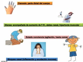 CCiiaannoossiiss:: ppaarrttee ddiissttaall ddeell ccuueerrppoo 
Disnea: acompañada de aumento de F.R., aalleetteeoo nnaassaall,, hhiippeerrttoonnííaa mmuussccuullaarr 
EEssttaaddoo ccoonncciieenncciiaa ((aaggiittaacciióónn,, hhaassttaa ccoommaa)) 
BBllooqquueeoo nnaassaall ((iinnffllaammaacciióónn yy eexxuuddaacciióónn mmuuccoossaa)) 
 