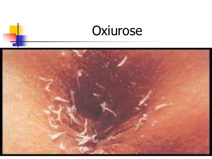 O que e verme oxiurus. Verme oxiurus sintomas, Verme oxiurus sintomas tratamento.