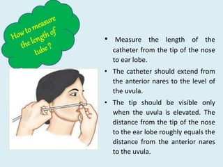 • Measure the length of the
catheter from the tip of the nose
to ear lobe.
• The catheter should extend from
the anterior nares to the level of
the uvula.
• The tip should be visible only
when the uvula is elevated. The
distance from the tip of the nose
to the ear lobe roughly equals the
distance from the anterior nares
to the uvula.
 